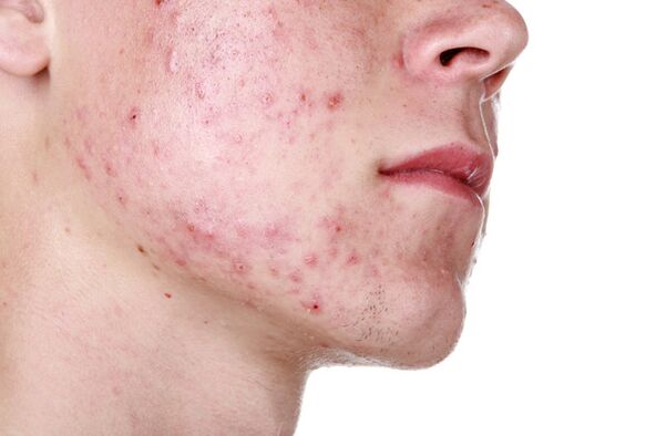 Skin lesions of the face with demodicosis